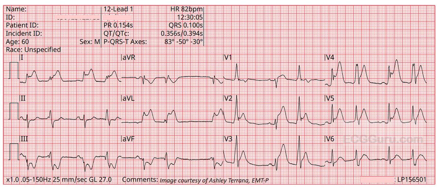 Acute anterior lateral stemi ecg guru instructor resources